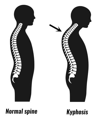 Tech Neck Could Be Causing Your Neck Pain - FAQ