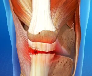 patellar tendon rupture image