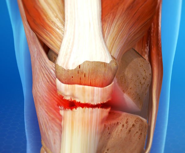 Patellar Tendon Rupture Recovery Time