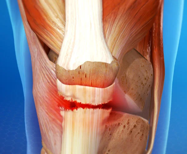 Patella Tendinopathy & the 4-stage management program for