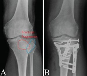x-rays showing tibial plateau fracture with fixation