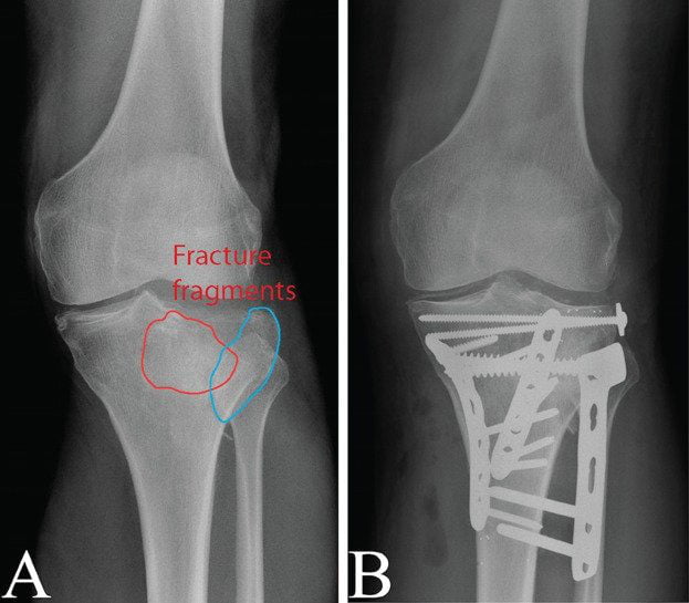 tibial plateau fracture swelling